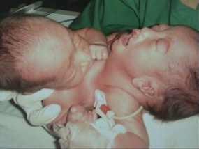 Bayi Kembar Siam Dirujuk ke RSUP Adam Malik