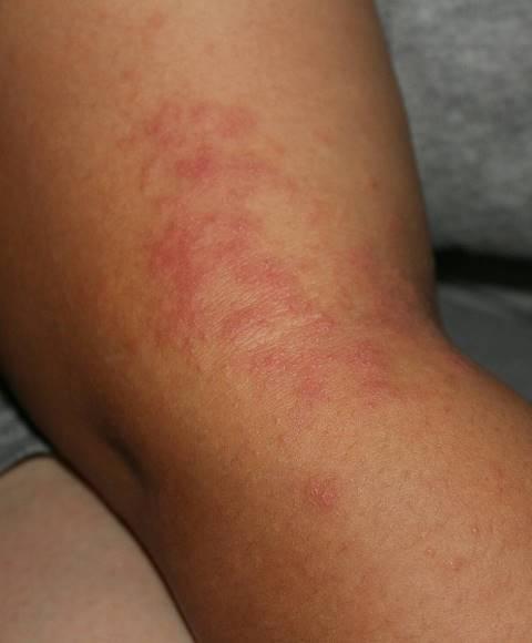 Apa itu Eksim ? Mari Waspada Penyakit Eksim Pada Kulit.