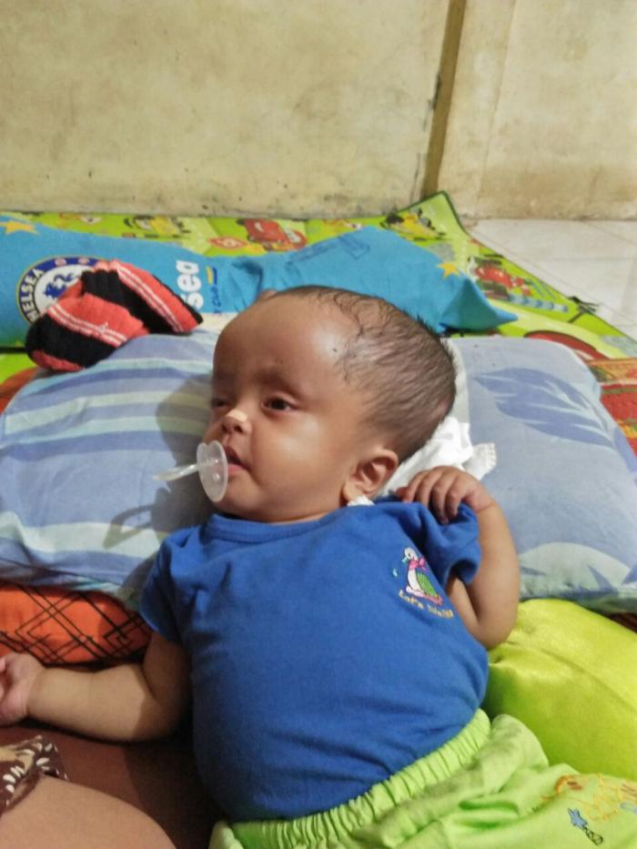 Bayi Penderita Hidrosefalus Ditemukan di Padangsidimpuan